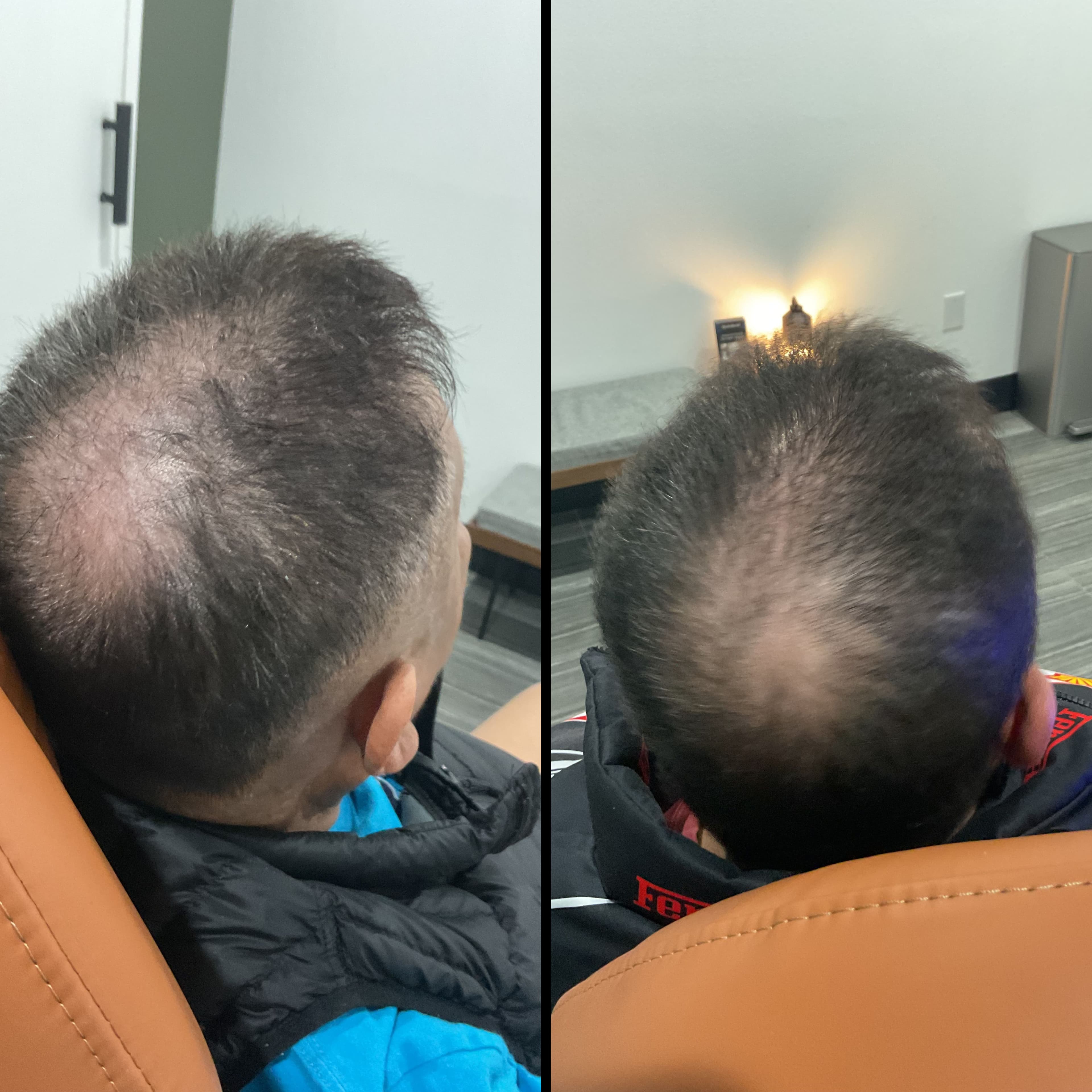 PRF Hair Restoration (Full)