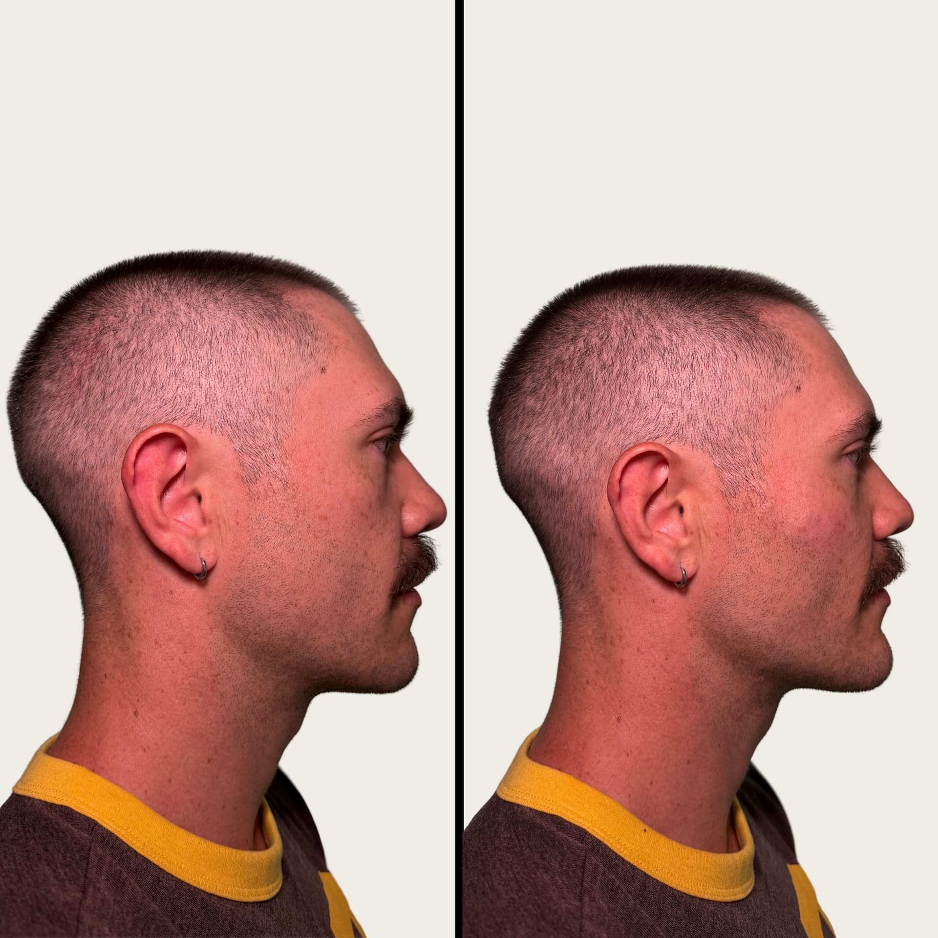 Jawline Filler
