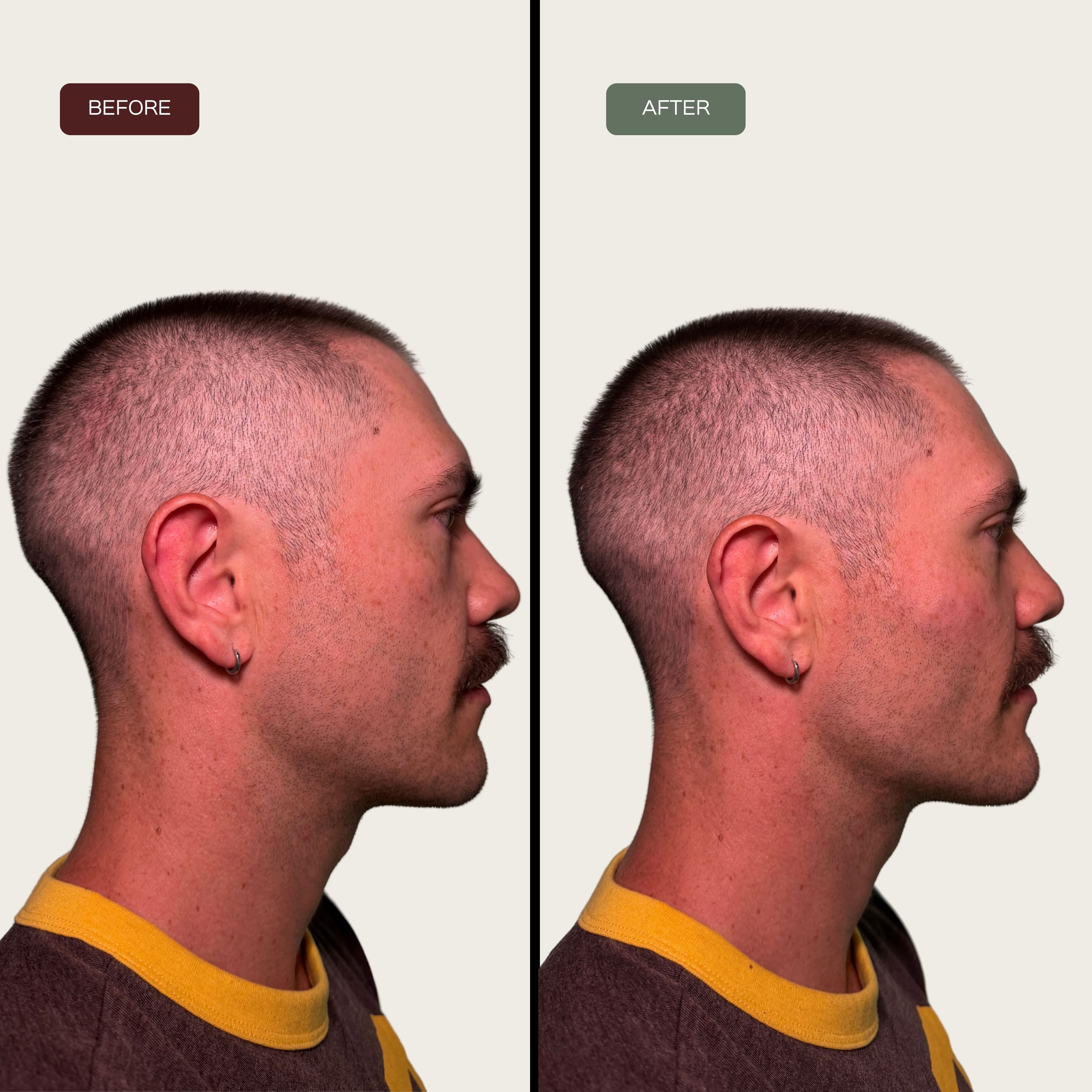 Jawline Filler