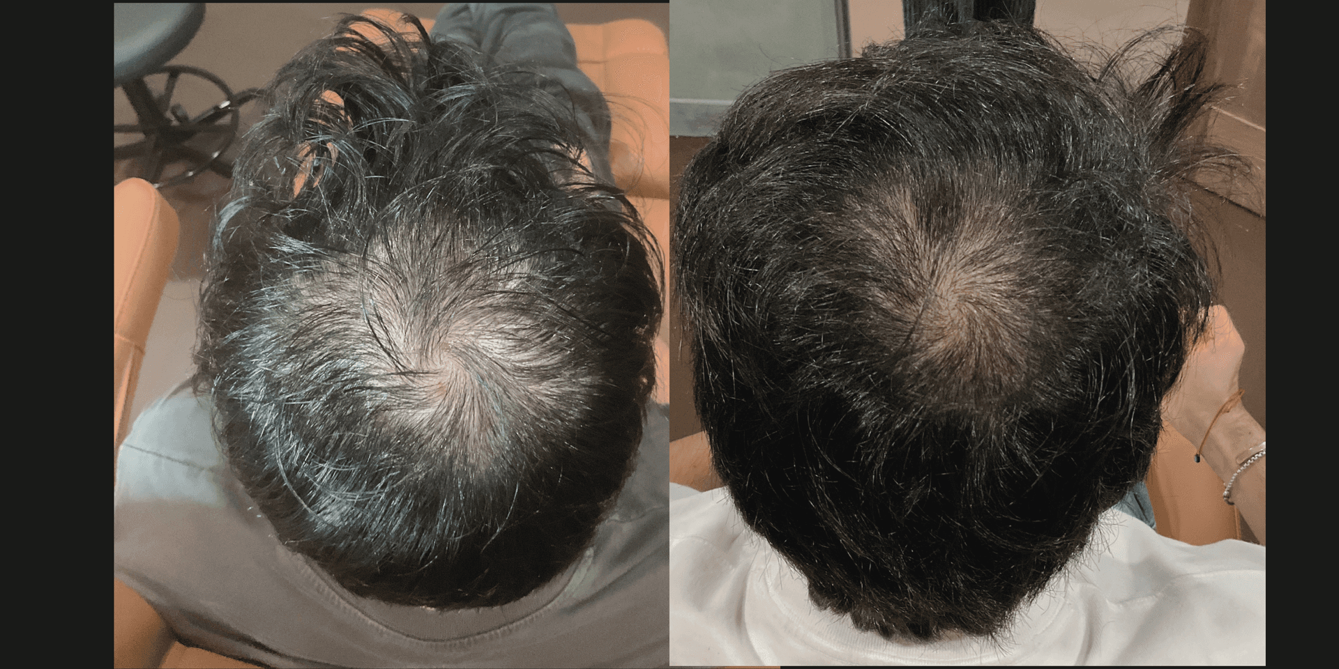 PDGF Hair Restoration