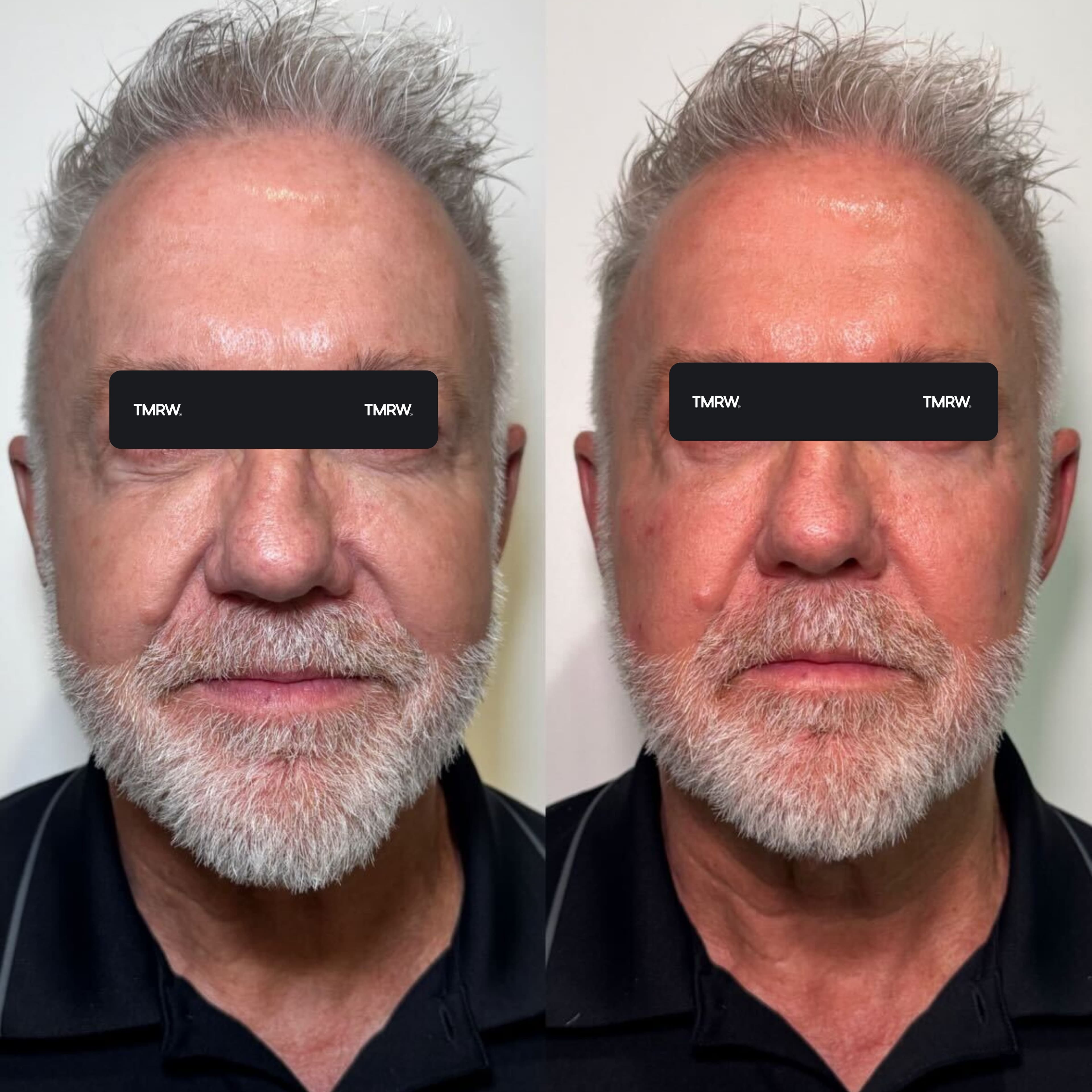 Dark Circles Under Eyes