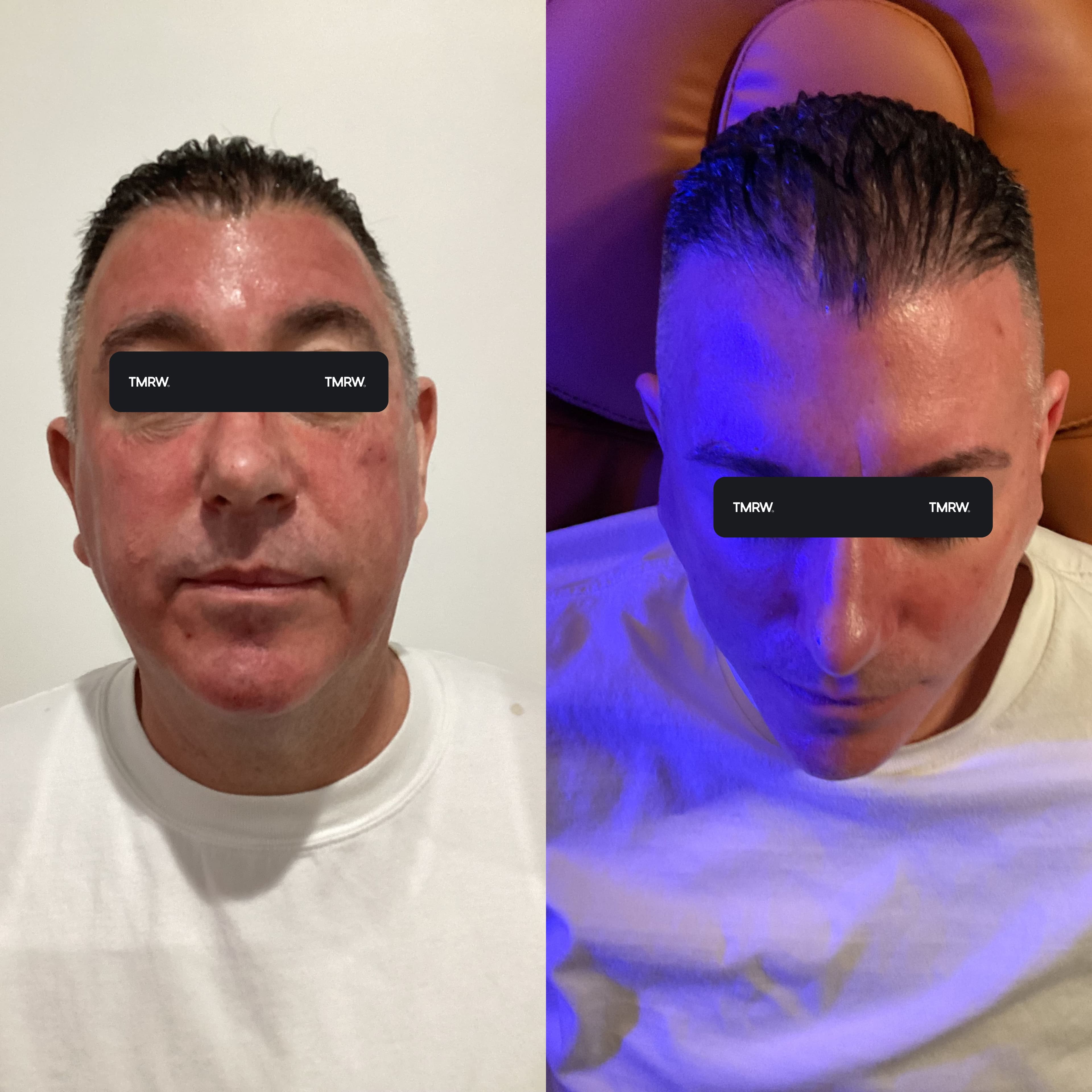 Skin Texture & Scarring