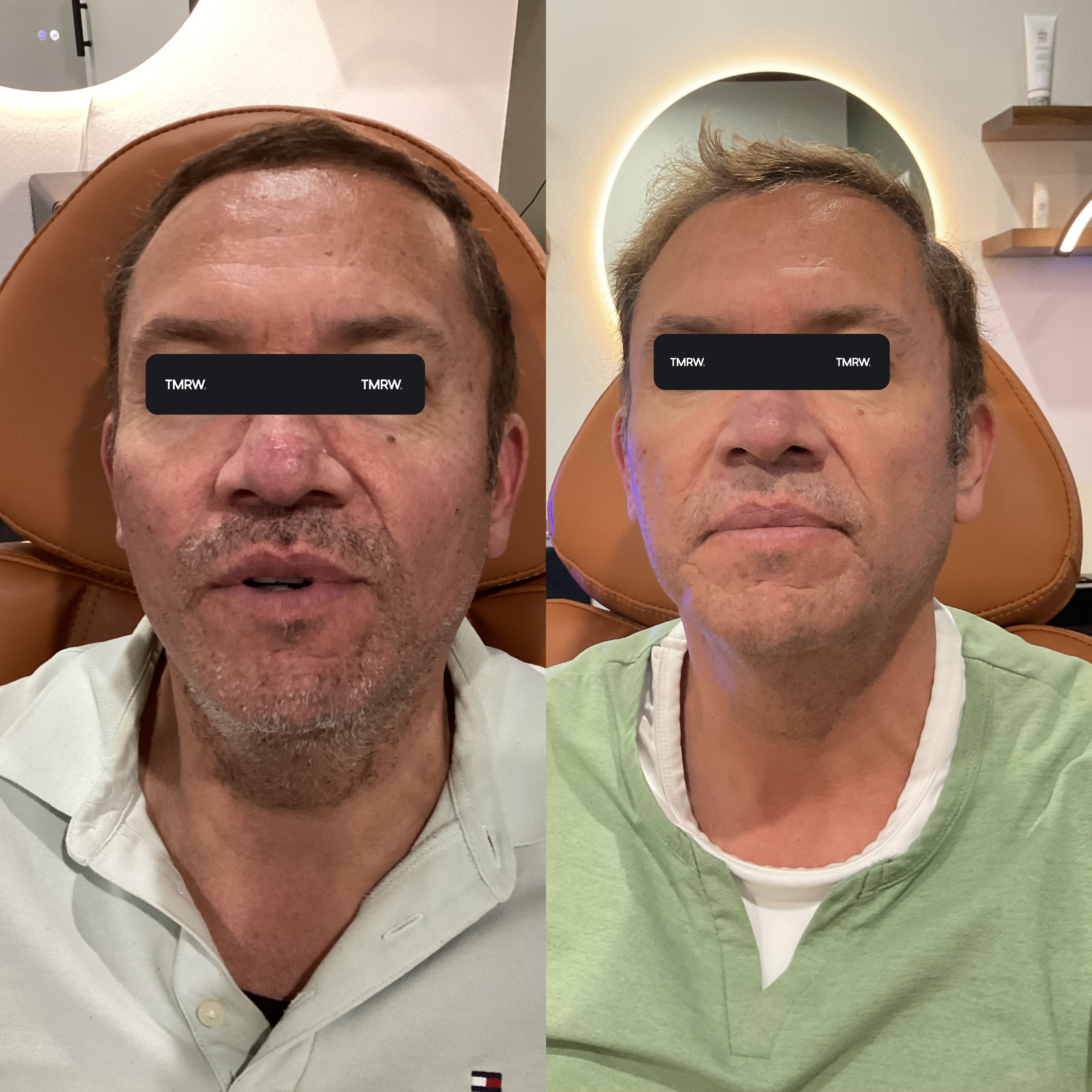 Skin Texture & Scarring