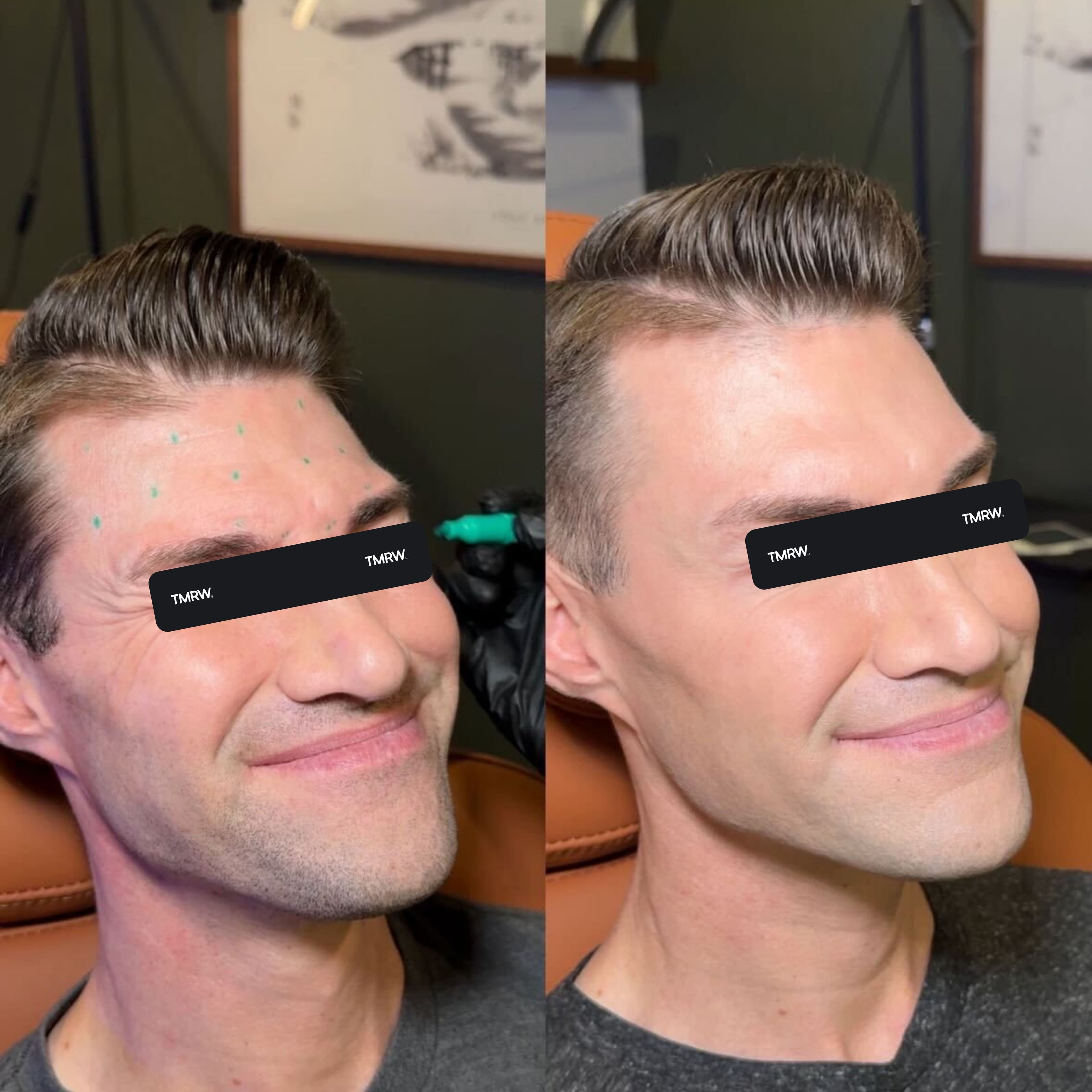 Wrinkles & Fine Lines