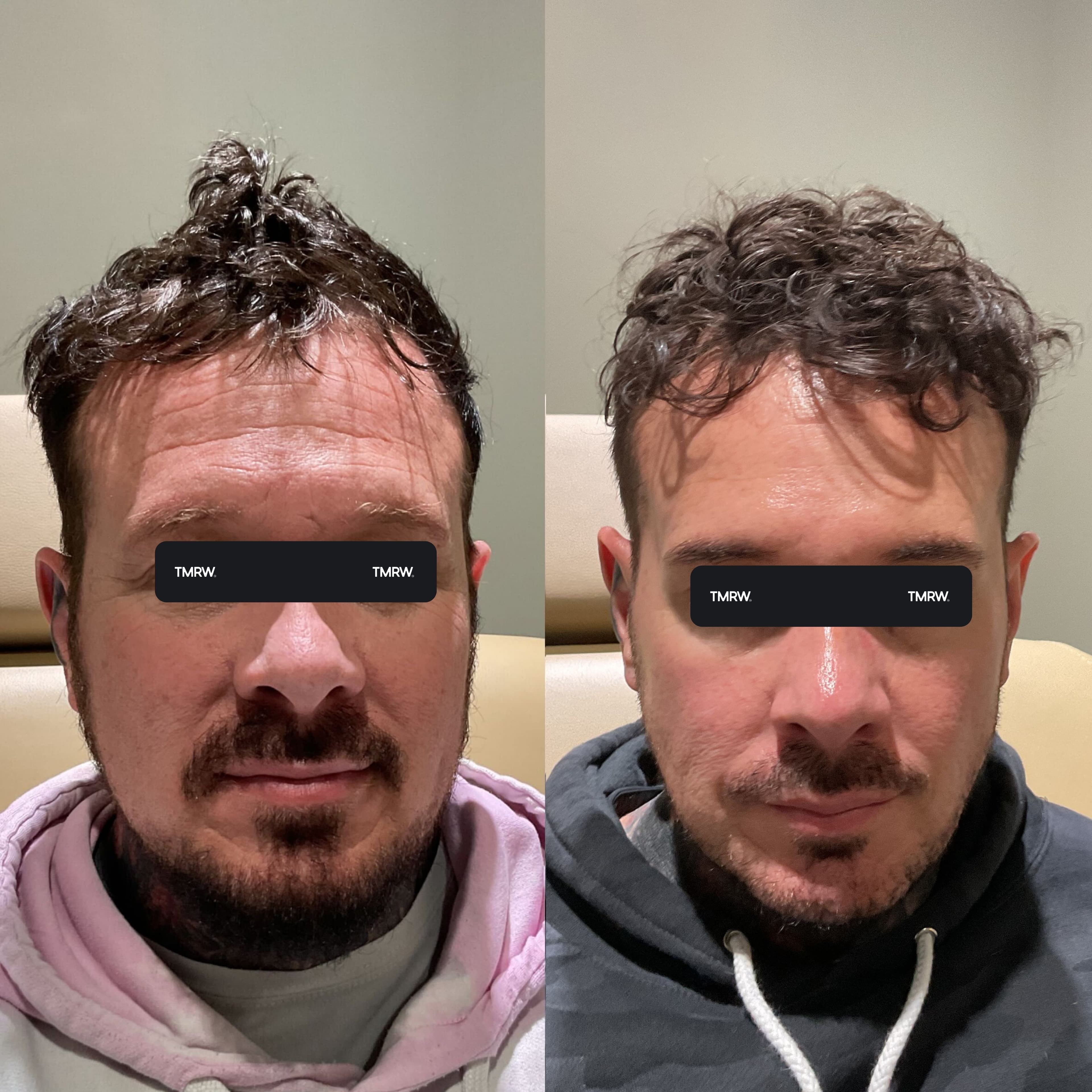 Wrinkles & Fine Lines