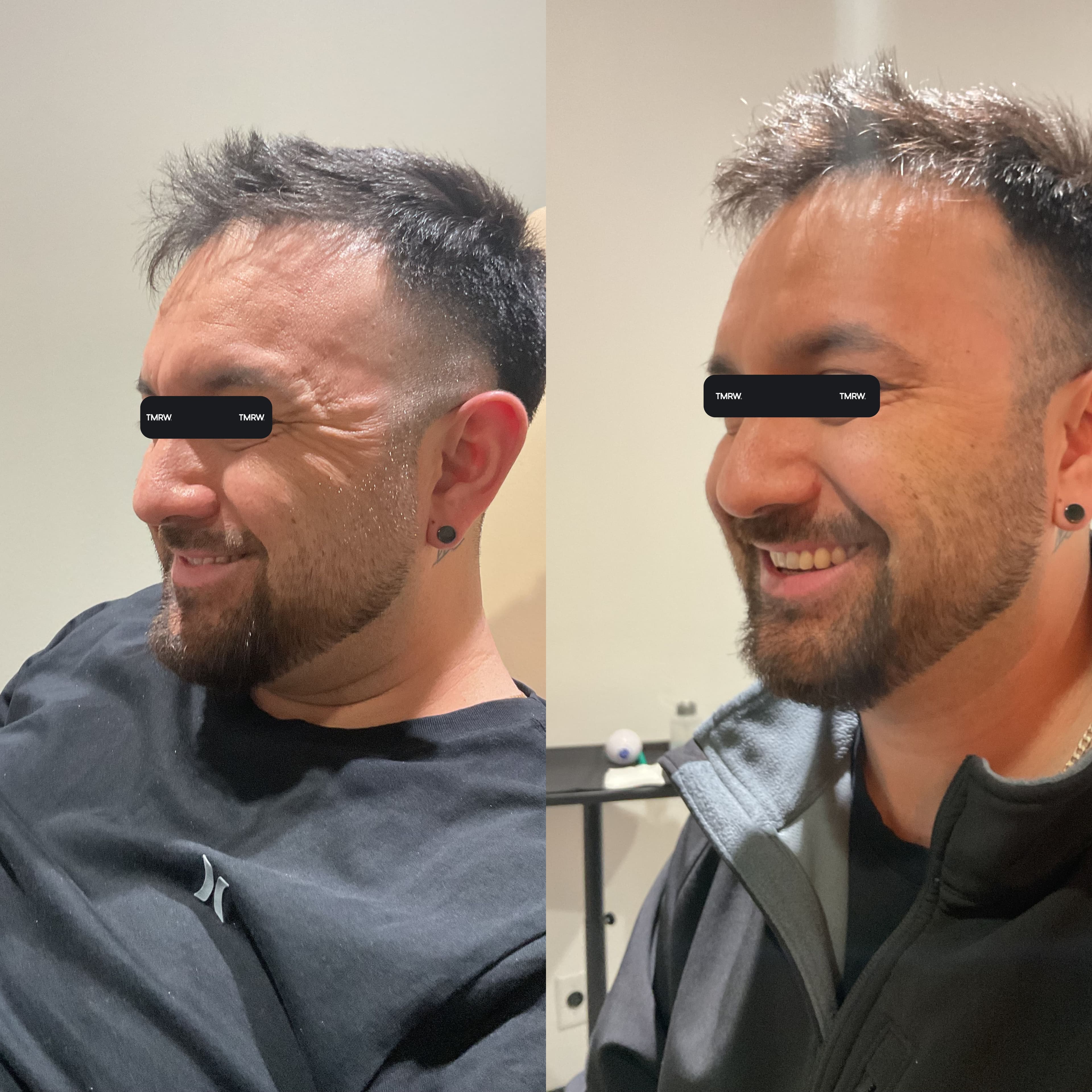 Wrinkles & Fine Lines