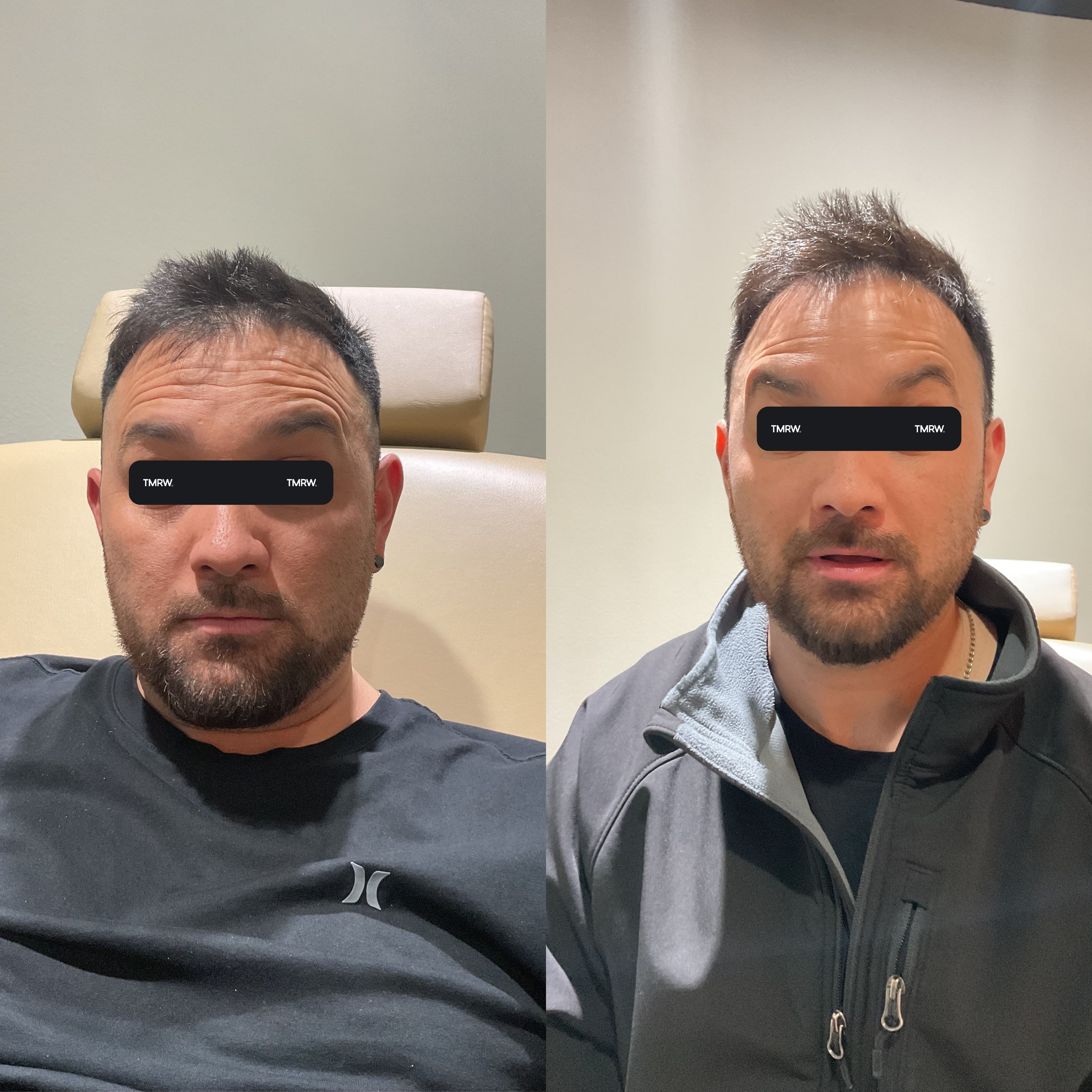 Wrinkles & Fine Lines