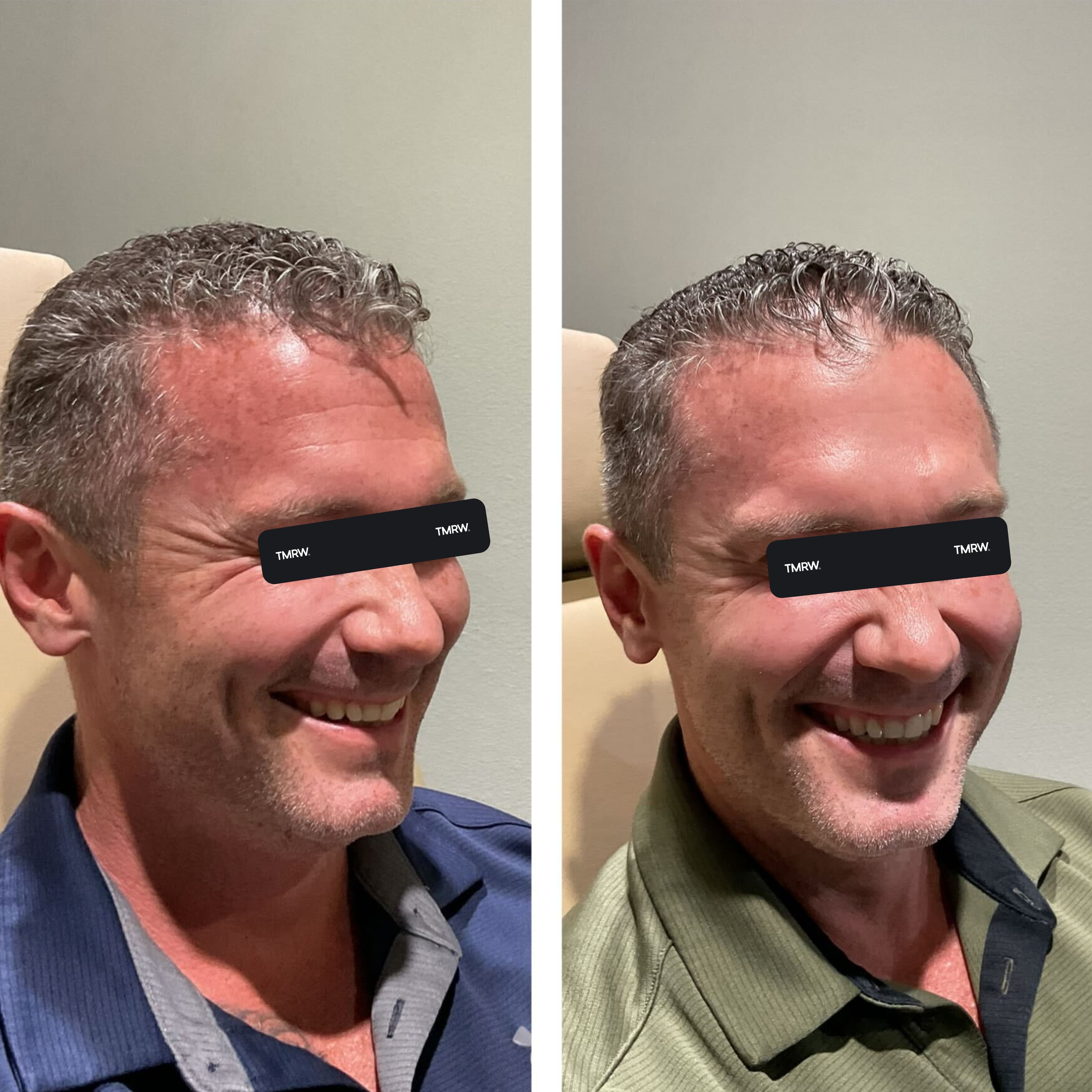 Wrinkles & Fine Lines