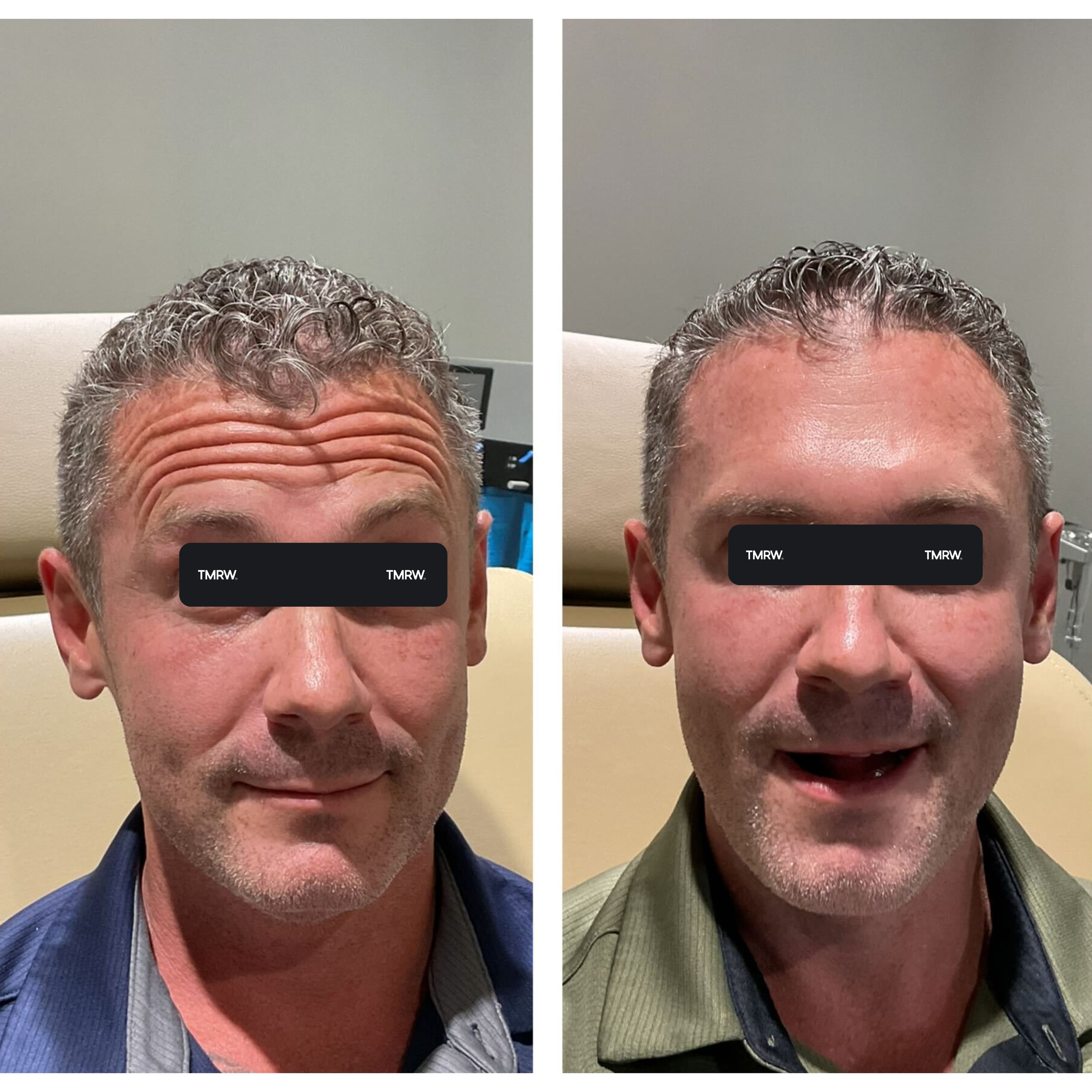 Wrinkles & Fine Lines