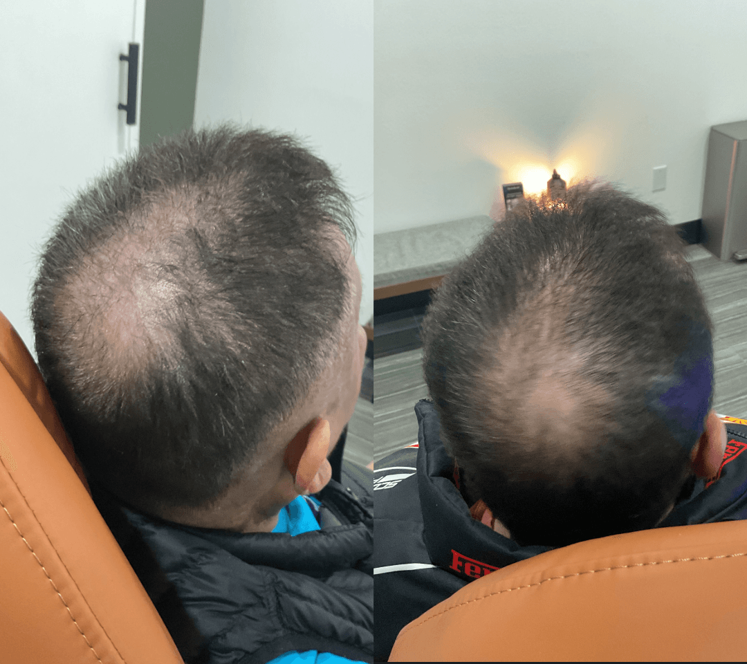 What Is PRF Hair Restoration?