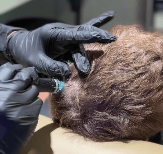 Hair Loss Isn't Random—It's Predictable