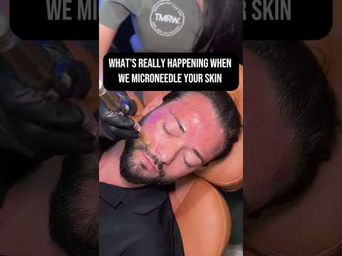 Fades Acne Scars testimonial